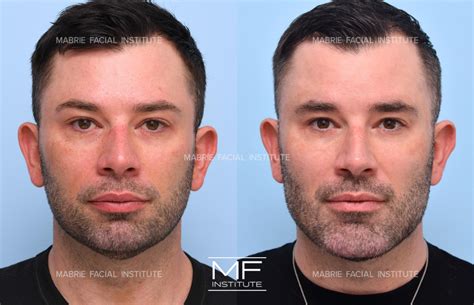 Complete Facial Rejuvenation or Contouring Before and After Pictures