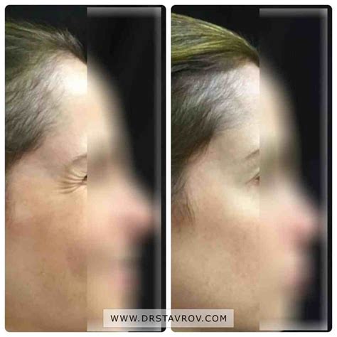 Ботокс на лице. Цени. За какво се използва? - Dr. Stavrov Aesthetics