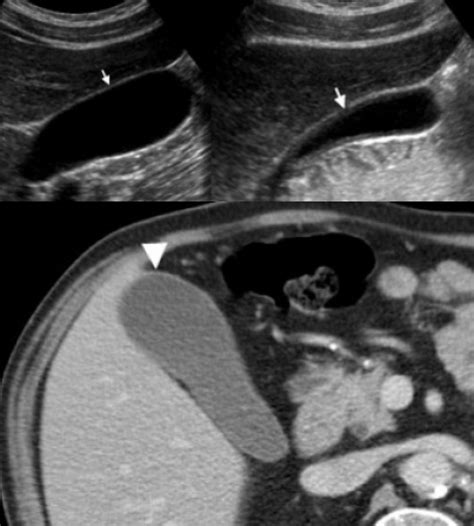 Желчный пузырь — 24Radiology.ru