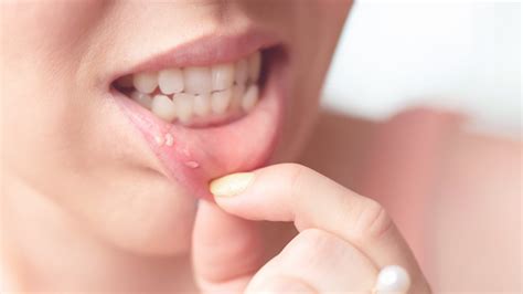canker sores    lips