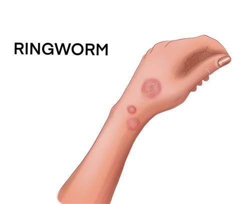 Early Ringworm In Humans
