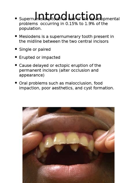 Supernumerary Tooth | Mouth | Health Sciences