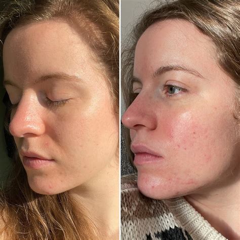 Skin gradually gets redder throughout the day - what could be causing