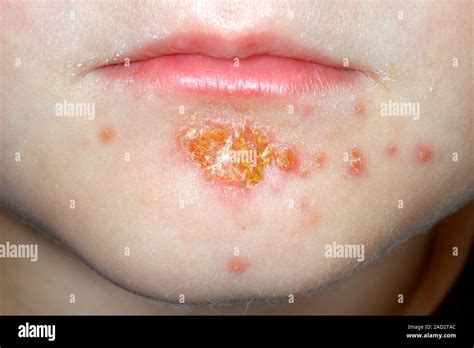 Impetigo. Close-up of a rash around the mouth of a 4-year-old male ...