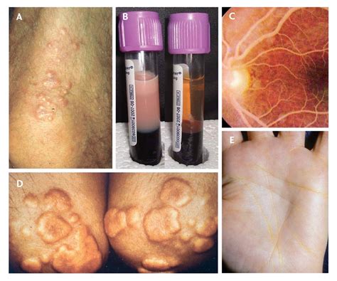 Hypertriglyceridemia: its etiology, effects and treatment. - Abstract ...