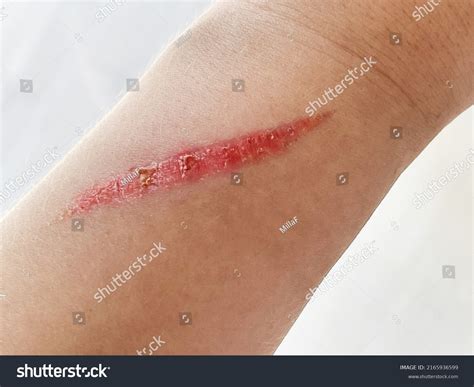 Close Burn Scar On Womans Hand Stock Photo 2165936599 | Shutterstock