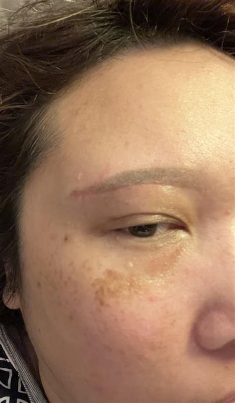 The scars won’t go away. It’s been more than 3 months! Help : r