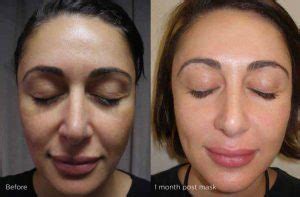 depigmentation therapies skin care