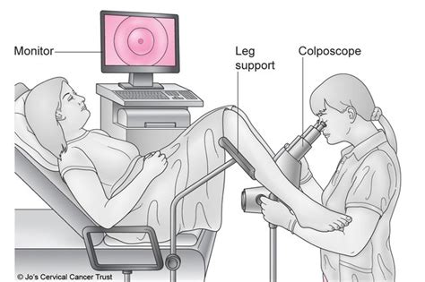 colposcopy   nhs