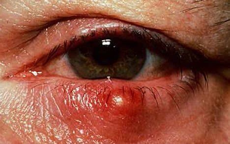 Mata Bintitan Sembuh Sendiri? Berapa Lama?