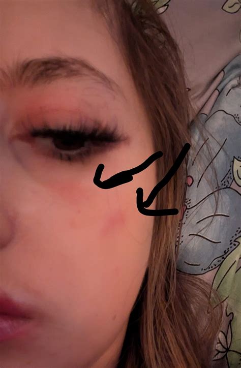 Allergische Reaktion gegen ein Pflegepersonal, was tun? (Haut, Gesicht