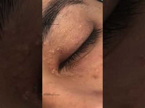 Milia Hyfrecation - YouTube