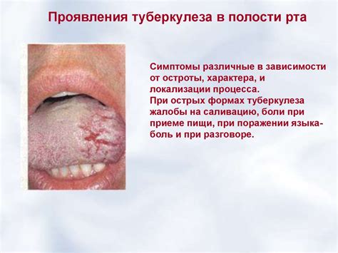 Туберкулез в полости рта - презентация онлайн