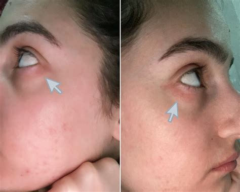 Eye Itching Outside Corner at Gloria Harris blog