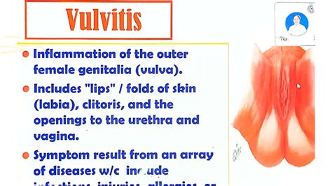 cs maternal health understanding vulvitis  vaginitis studocu