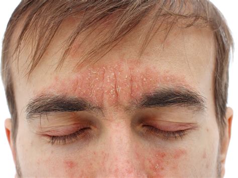 Pin on Scalp Seborrheic Dermatitis