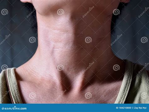 smooth diffuse thyroid swelling  southeast asian burmese young man