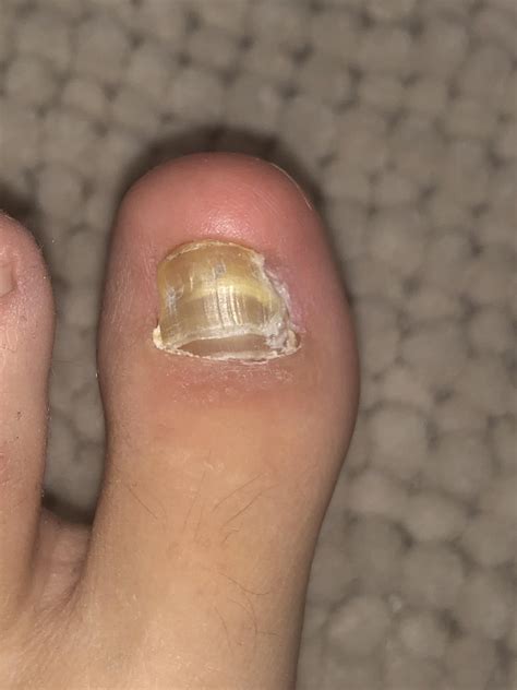 Hard and thick toenail 6 months after being removed. Why does it look