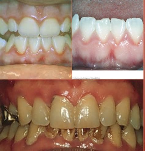 Gingival description Flashcards | Quizlet