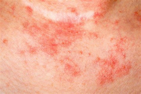 Eczema vs Psoriasis: What You Should Know | ThriveNaija