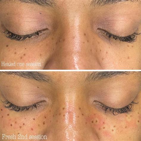 Semi-Permanent Freckle Tattoos: The Ultimate Guide