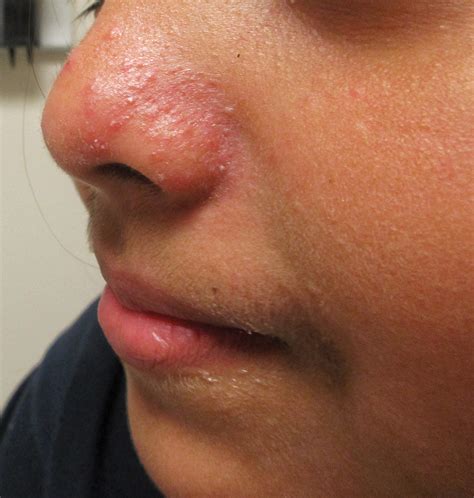 Erythematous Papules and Pustules on the Nose | MDedge Dermatology