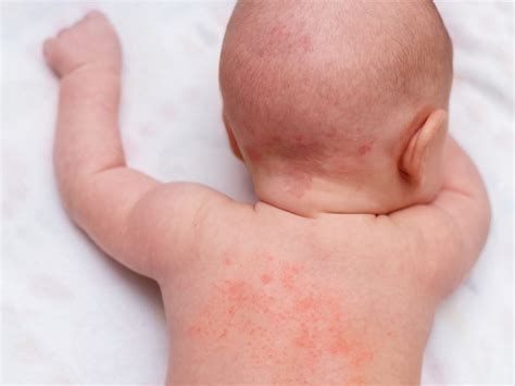 RASHES IN CHILDREN | Chandigarh Ayurved & Panchakarma Centre