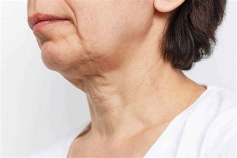 Sagging Neck: Best treatment to treat it | Dr. Anthony Bared | Miami