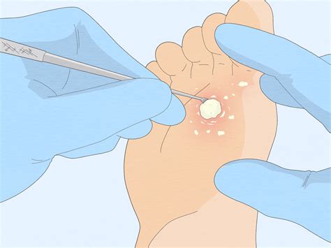How to Get Rid of a Mosaic Wart: Home Remedies & Treatment