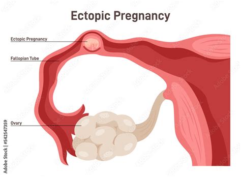 ectopic pregnancy tubal pregnancy medical illustration embryo stock