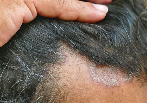 Mild Scalp Dermatitis