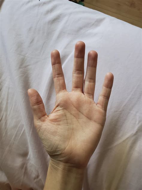 32 best r/ichthyosis images on Pholder | Someone on Reddit told me I