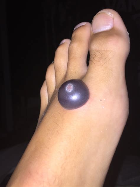 Liquid Nitrogen On Warts