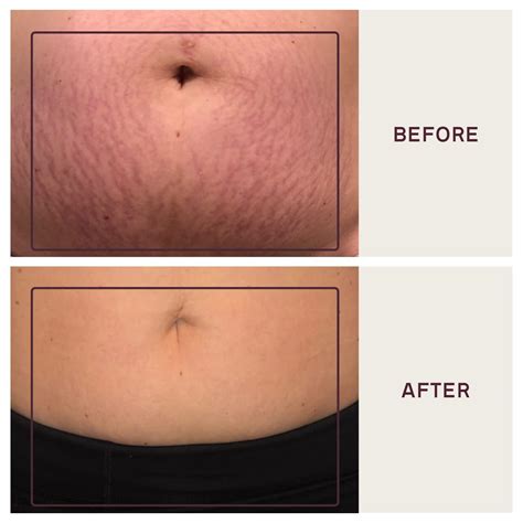 Skin patches might soon prevent the visible marks of hickeys 2