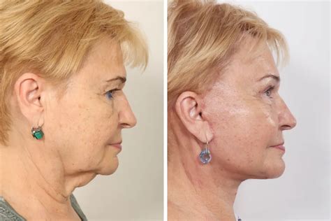 Facelift Before and After Photos | Dr. Benjamin Paul