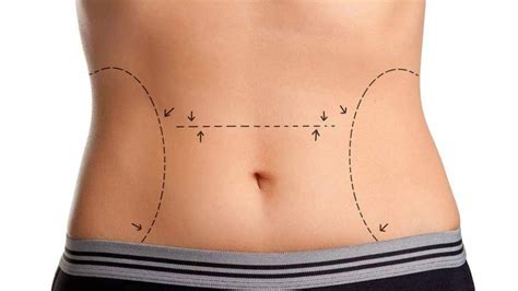 Expert Liposculpture Surgeons in Colombia: Aesthetic Precision with ...