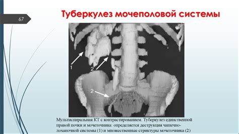 Внелегочный туберкулез - презентация онлайн