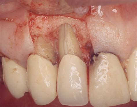 Biomechanics Of Fractures In Endodontically Treated Teeth – VJIPHE