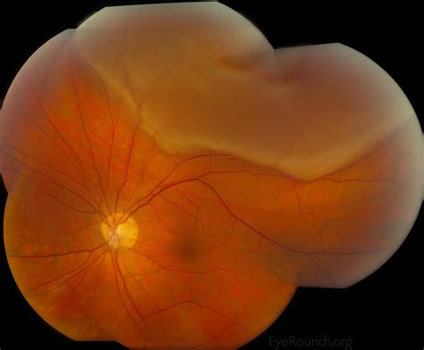 Posterior Vitreous Detachment Pvd Model Gulden Ophtha - vrogue.co