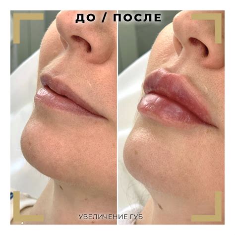 Техники увеличения губ. Что можно сделать с губами в кабинете косметолога?