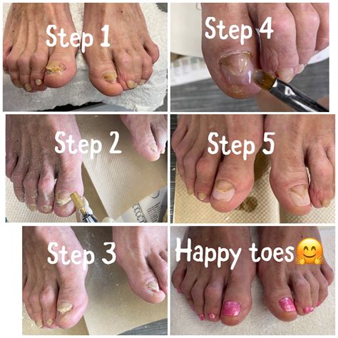 Toenails Transformation | Toe nails, Nail spa, Gel