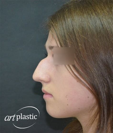 Ринопластика / Фото / Альбом №1 | Клиника Art-Plastic