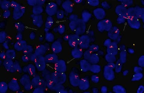 A MYC rearrangement positive case with 5' MYC amplification. | Download ...