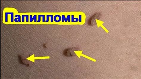 Удаление папиллом в домашних условиях, йодом и спиртом