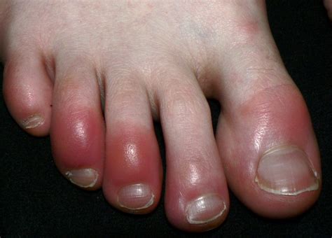 chilblains foot talk podiatry