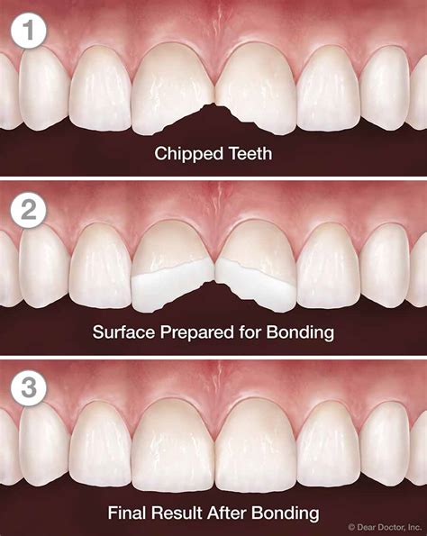 How To Fix A Chipped Tooth - Chipped Teeth | Family and Children’s Dentistry | Atlanta Georgia