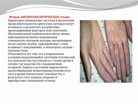 Болезнь Рейно - презентация онлайн