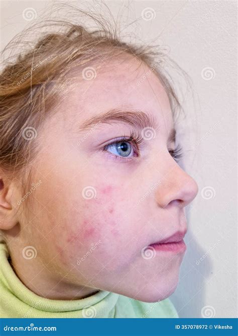 Allergic Rash Skin Of Patient Arm Stock Photo | CartoonDealer.com #44873016