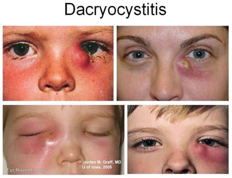 Dacryocystitis is an infection of the lacrimal sac, secondary to ...