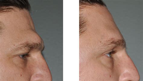 prominent brow ridge